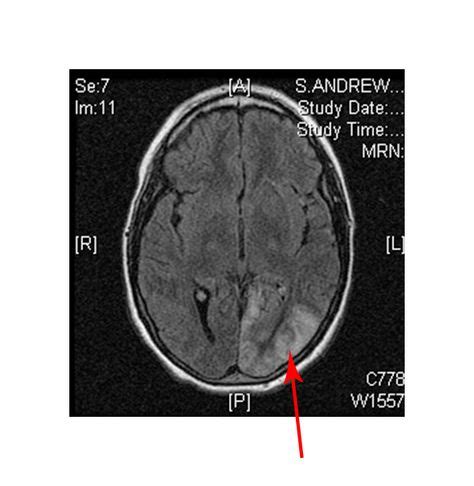 MRI Stroke occipital lobe in MELAS patient | Occipital lobe, Psychiatry, Metabolism