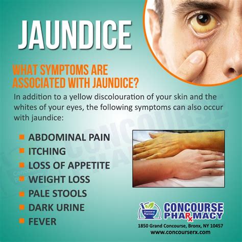 What are the Symptoms of Jaundice | Jaundice symptoms, Pharmacy ...