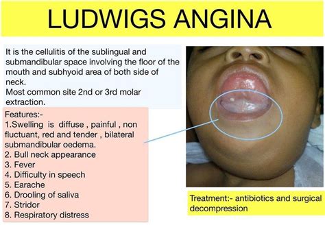 Ludwig Angina - MEDizzy