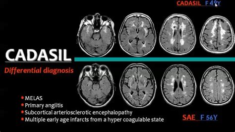 white matter disease mri Mri lesions diffuse axial - Diseases Club center