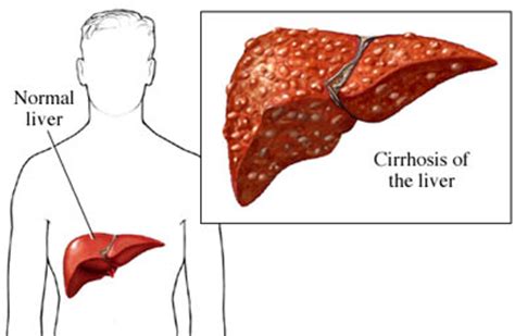 End Stage Cirrhosis | New Health Guide