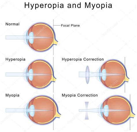 Miopia e hipermetropia — Vetor de Stock © mrhighsky #67034327