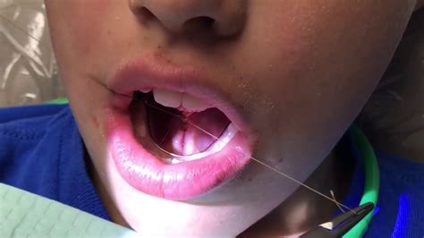 Lingual Frenectomy Before And After