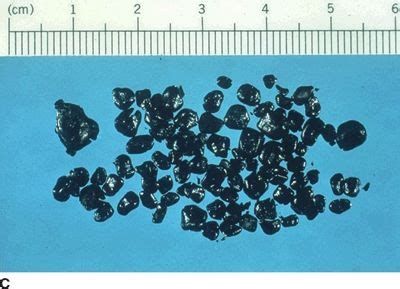 Pigment Gallstones