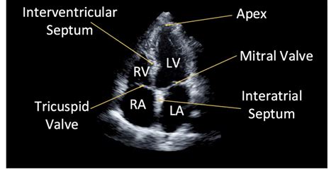 Cardiac Ultrasonogram Showing Apical Chamber View, 60% OFF