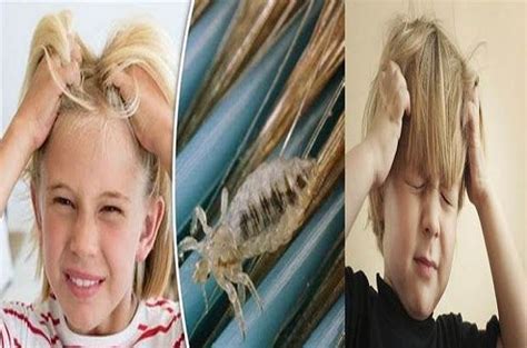 Head Lice: Symptoms and Causes -Home Remedies for Treating Head Lice