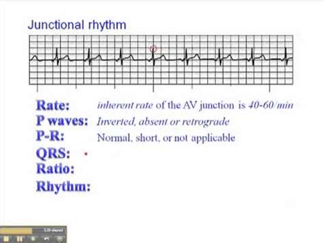 What Does A Junctional Rhythm Mean Top Sellers | www.jkuat.ac.ke