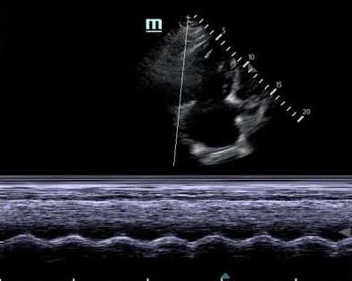 Tapse Echocardiography Normal & Abnormal Value, Measurement