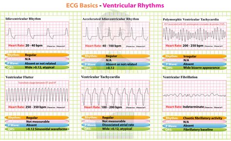 Ventricular Rhythms | Ekg interpretation, Ecg rhythms, Nursing mnemonics