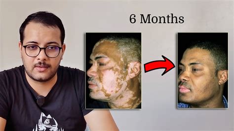 OPZELURA ( Ruxolitinib ), finally a cure for VITILIGO !! - YouTube