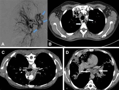 A B: Hypertrophy of bronchial arteries in the same patient can be seen... | Download Scientific ...