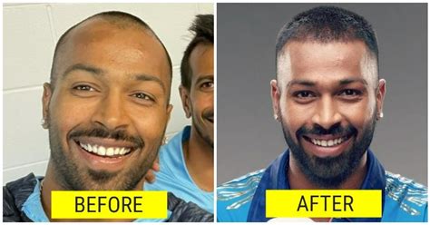 Indian Cricketers Who Seemingly Got Hair Transplant Secretly