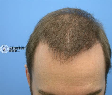 Hair Transplant 3 Month Results