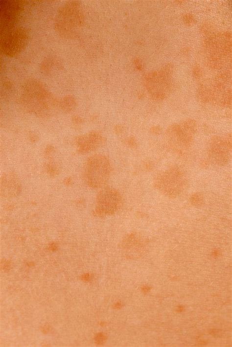 The bad news? If you get tinea versicolor once, you'll probably get it ...