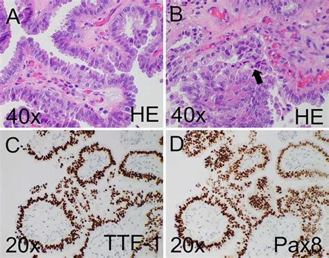 Histology of choroid plexus metastasis. Microscopic examination shows... | Download Scientific ...