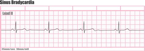 Bradycardia - Sinus Bradycardia Causes, Symptoms, Diagnosis, Treatment