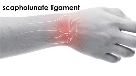 Scapholunate ligament – Physio Plus