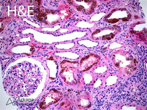 Renal Hemosiderosis | Teaching Points | Arkana Laboratories