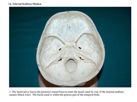 1a. Internal Auditory Meatus - ppt download