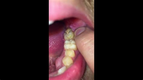 Infection after wisdom teeth removal - YouTube