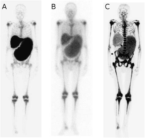 bone marrow scintigraphy | Semantic Scholar