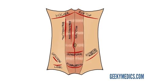 Abdominal Surgical Incisions | Gridiron | Pfannenstiel - Bhaskar Health ...