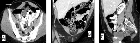 Histology Of Intramuscular Lipoma | Sitelip.org