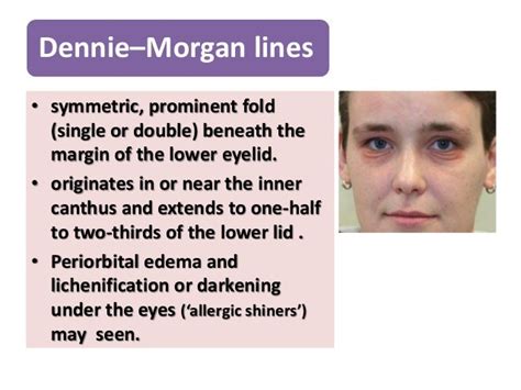 Dennie Morgan Lines Treatment - Pregnant Health Tips