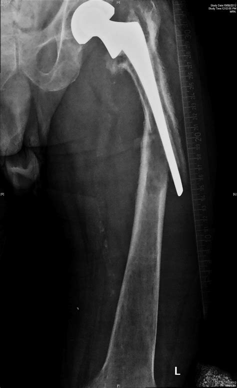 Joint Preservation and Replacement : Type 3 periprosthetic fracture Lt hip