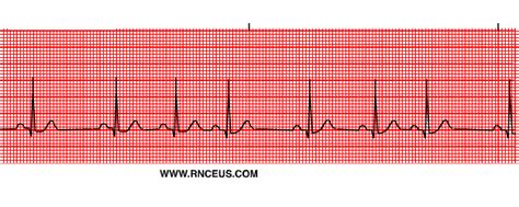 Sinus Arrhythmia