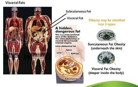 Visceral Fat: How The Fat In Your Organs Is Really Killing You – 166 - Medici Enterprises