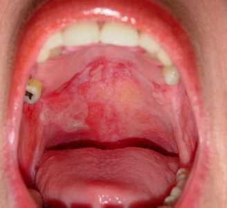 Canker Sore Back Of Throat