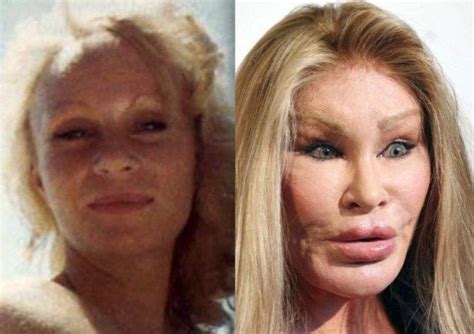 Celebrities Epic Face Lift Failures