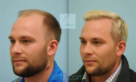 Pin by HairTX on Male Hair Transplant Results | Hair transplant results ...