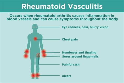 Vasculitis Conference 2024 - Hedda Eachelle