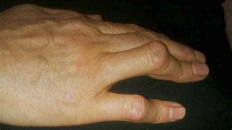 Rheumatoid Arthritis Hand Deformities: What to Do