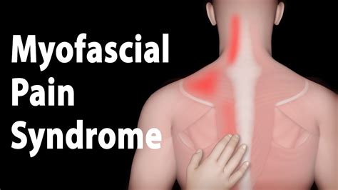 Myofascial Pain Syndrome and Trigger Points Treatments, Animation. - YouTube