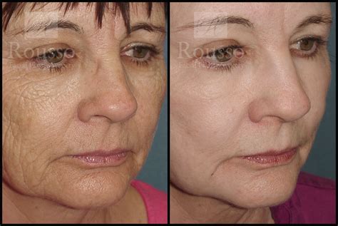 Patient 2126625 | Chemical Peel Before & After | Rousso Facial Plastic Surgery