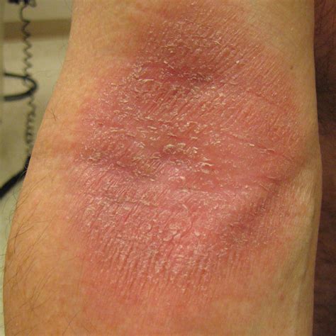 Psoriatic Arthritis Rash: Images, Symptoms, and Treatment - GoodRx