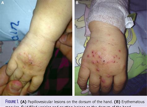 Figure 1 from Serratia marcessens infection presenting with papillovesicular rash similar to ...