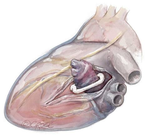 AtriClip Left Atrial Appendage Closure - Gold Coast