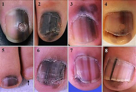 Hutchinson Sign Nail Melanoma - Nail Ftempo