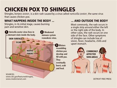 What you need to know about shingles infections