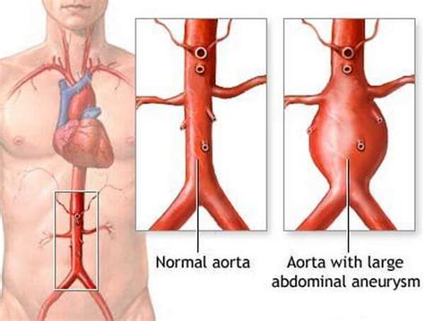 Aortic Aneurysm Disease: Causes, Symptom and Nursing Intervention