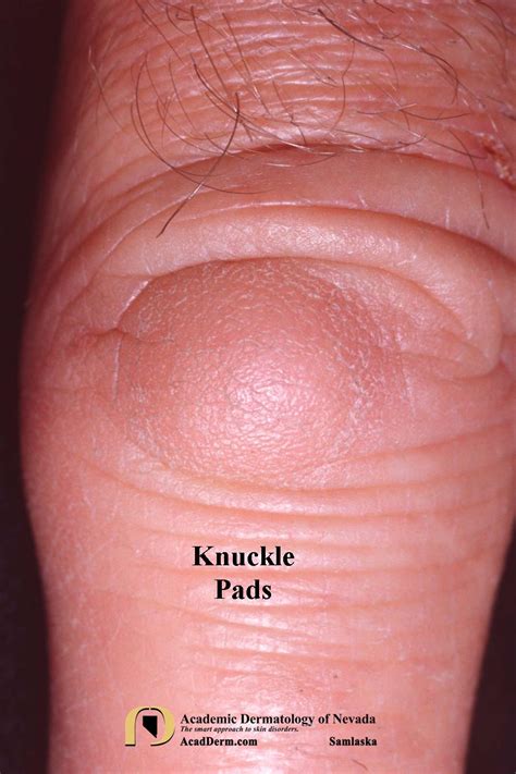 KnucklePads5Samlaska - Academic Dermatology of Nevada