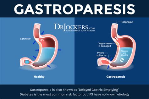 Gastroparesis: Symptoms, Causes and Natural Support Strategies