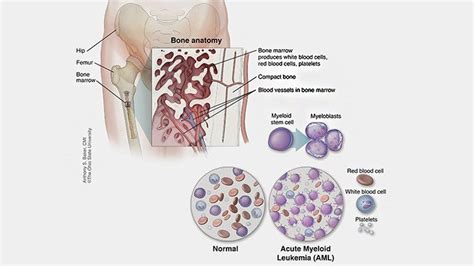 What Is Acute Myeloid Leukemia (AML)? Symptoms, Causes, Diagnosis ...