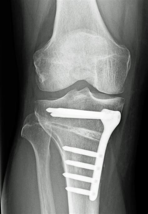 Osteotomy - Orthosport Victoria