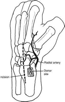 Open Reduction and Internal Fixation of Scaphoid Nonunion with ...