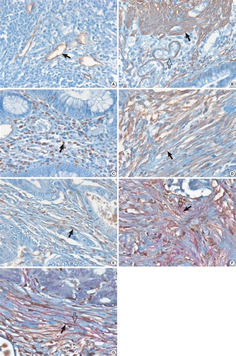 Immunohistochemistry for different markers of cancer associated... | Download Scientific Diagram